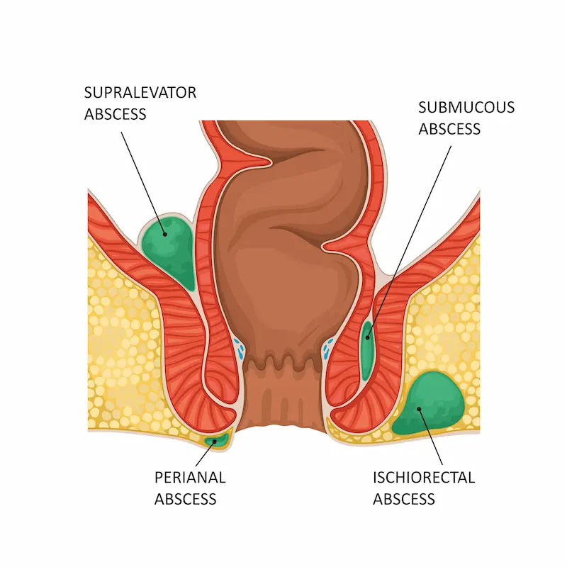 Perianal Abscess Overview and Management